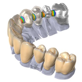 Модуль Exocad® DentalCAD