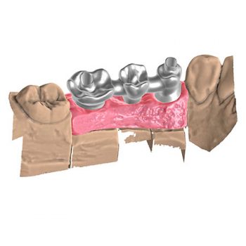 Модуль Exocad Implant