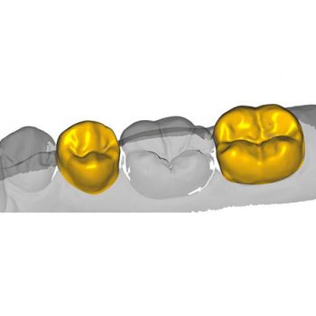 Модуль Exocad Provisional