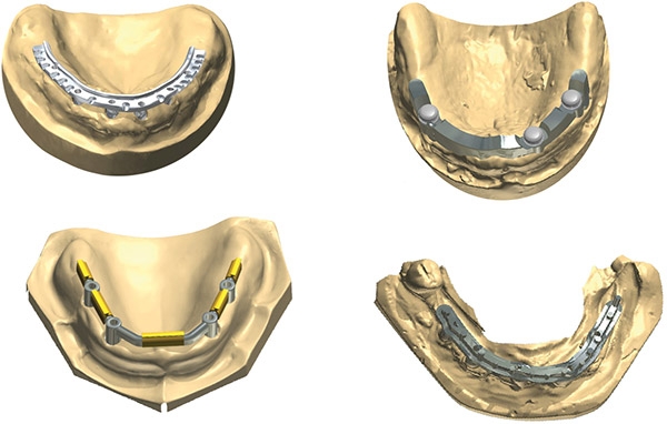 Фото ПО для стоматологии Implant Bar and Bridge Design - 1 seat _2