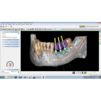 Софт для стоматологии SimPlant