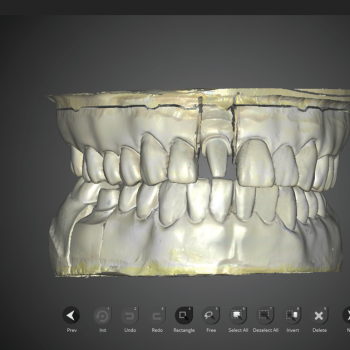 Изображение модели, отсканированной на 3D сканере Medit Identica T500 (2)